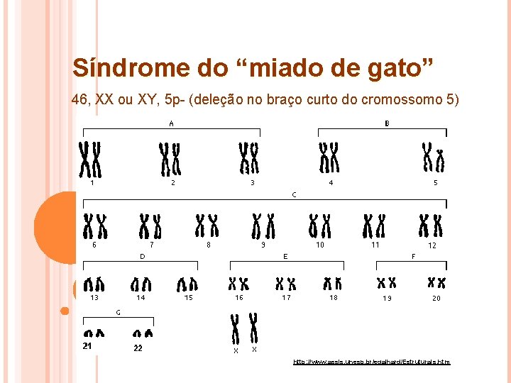 Síndrome do “miado de gato” 46, XX ou XY, 5 p- (deleção no braço