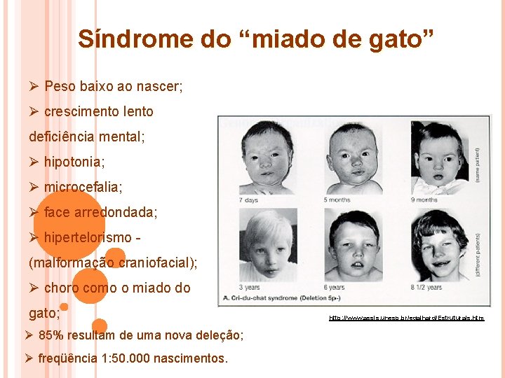 Síndrome do “miado de gato” Ø Peso baixo ao nascer; Ø crescimento lento deficiência