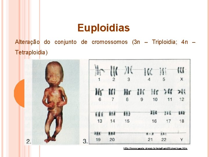 Euploidias Alteração do conjunto de cromossomos (3 n – Triploidia; 4 n – Tetraploidia)