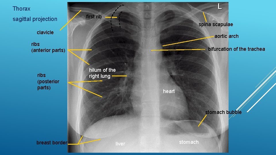Thorax sagittal projection first rib spina scapulae clavicle aortic arch ribs (anterior parts) ribs