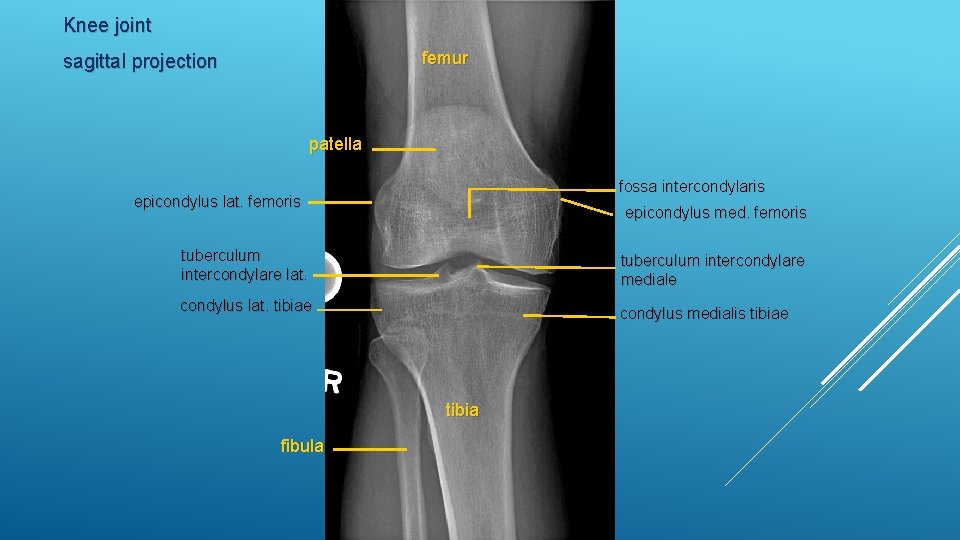 Knee joint femur sagittal projection patella fossa intercondylaris epicondylus lat. femoris epicondylus med. femoris