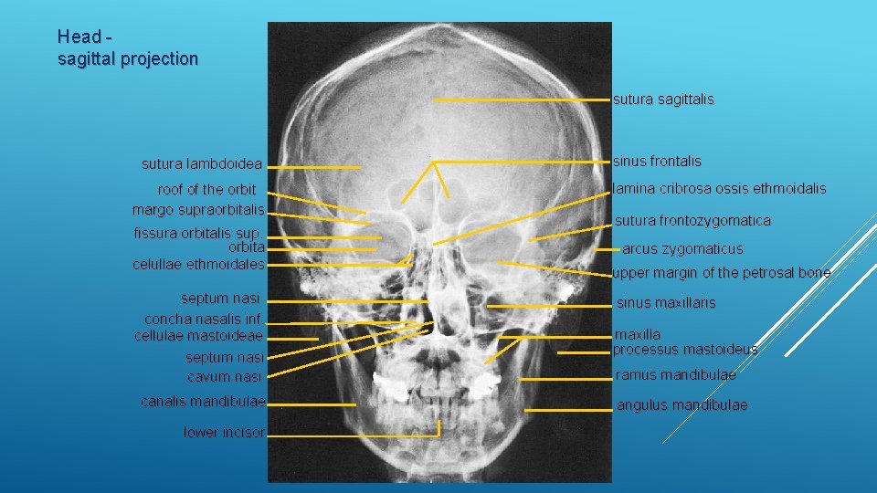 Head sagittal projection sutura sagittalis sutura lambdoidea roof of the orbit margo supraorbitalis fissura
