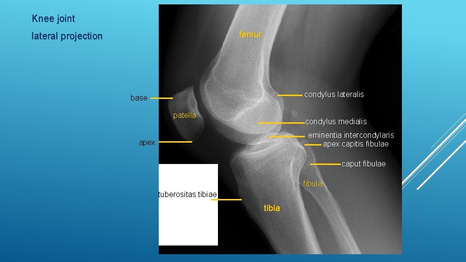Knee joint femur lateral projection condylus lateralis base patella condylus medialis eminentia intercondylaris apex