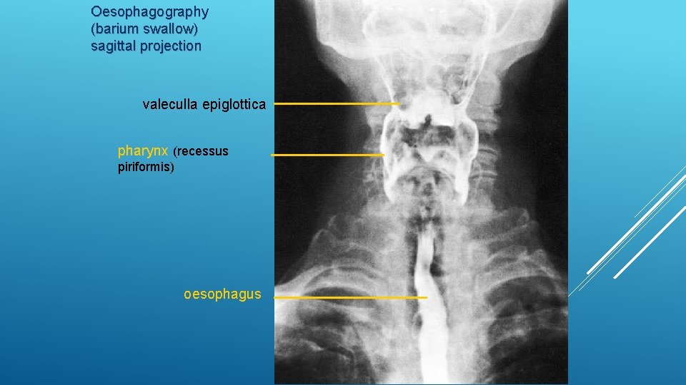 Oesophagography (barium swallow) sagittal projection valeculla epiglottica pharynx (recessus piriformis) oesophagus 