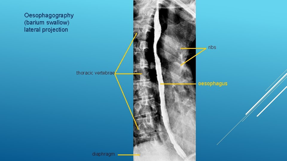 Oesophagography (barium swallow) lateral projection ribs thoracic vertebrae oesophagus diaphragm 
