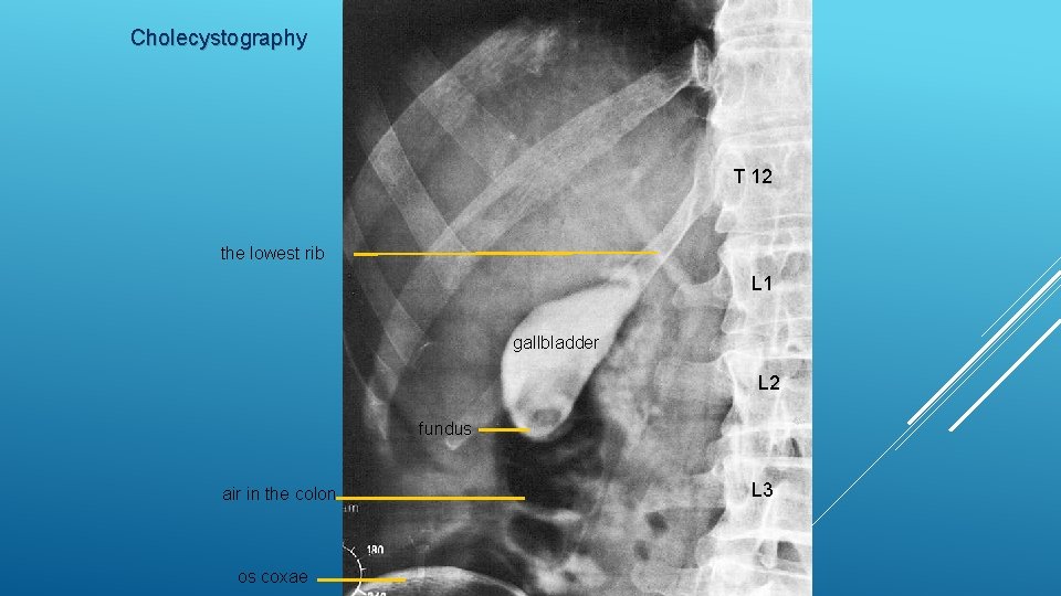 Cholecystography T 12 the lowest rib L 1 gallbladder L 2 fundus air in