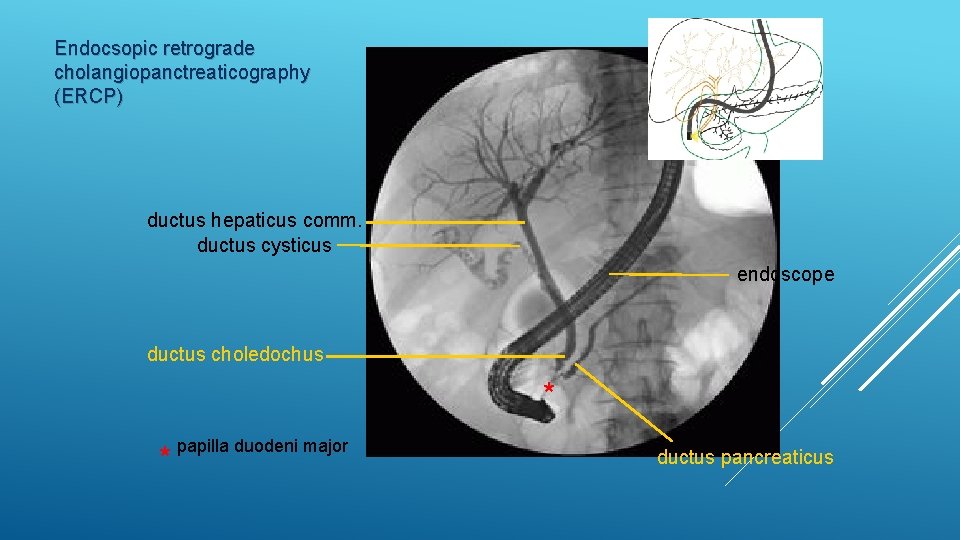 Endocsopic retrograde cholangiopanctreaticography (ERCP) ductus hepaticus comm. ductus cysticus endoscope ductus choledochus * *