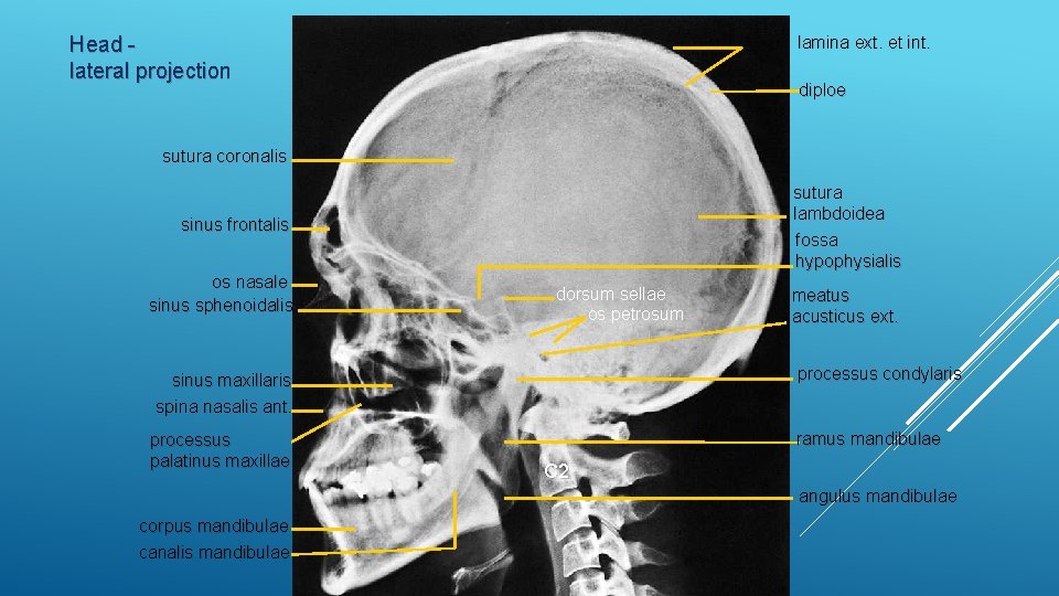 Head lateral projection lamina ext. et int. diploe sutura coronalis sutura lambdoidea fossa hypophysialis