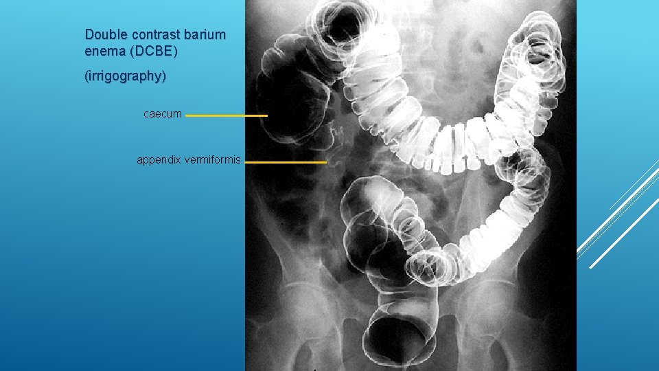 Double contrast barium enema (DCBE) (irrigography) caecum appendix vermiformis 