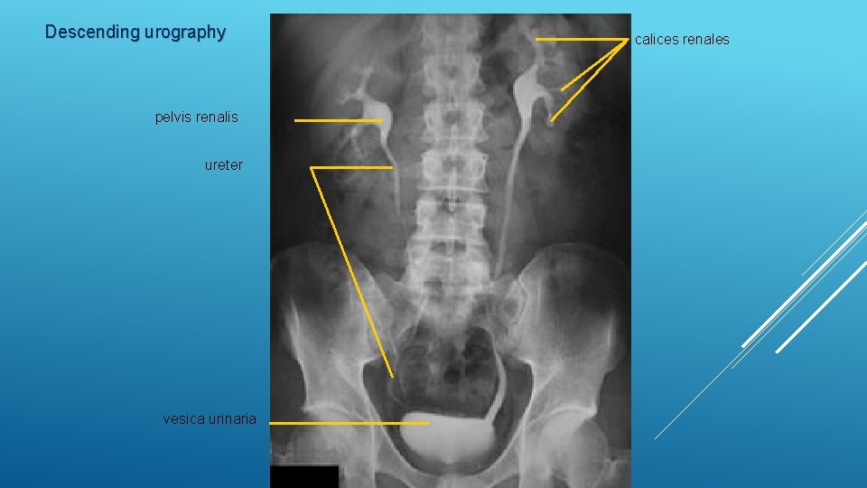 Descending urography pelvis renalis ureter vesica urinaria calices renales 