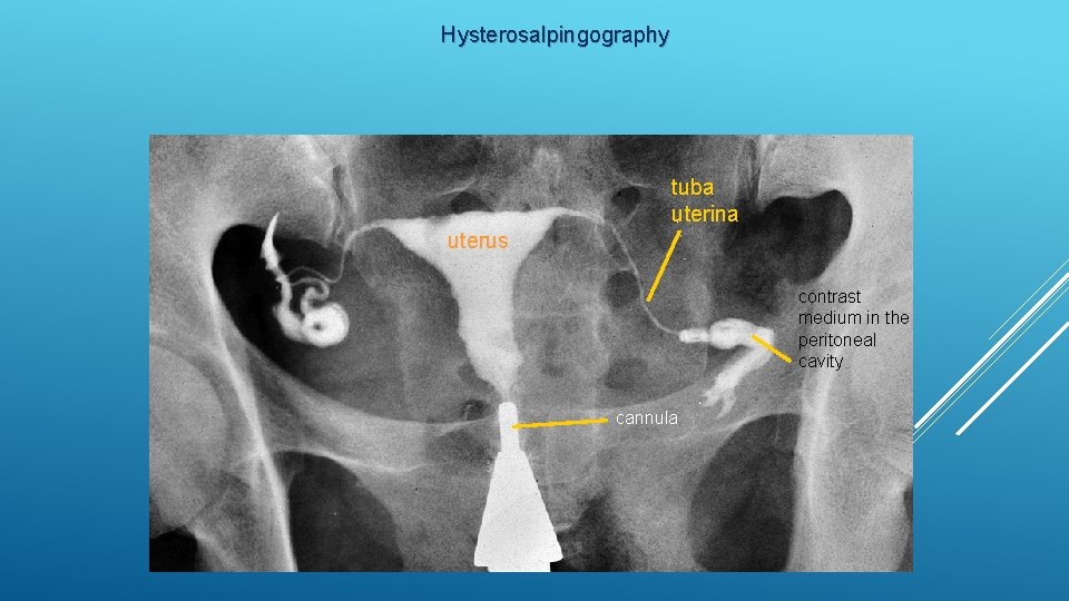 Hysterosalpingography tuba uterina uterus contrast medium in the peritoneal cavity cannula 