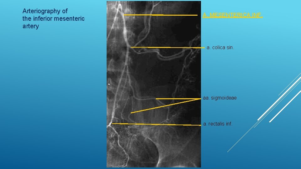 Arteriography of the inferior mesenteric artery A. MESENTERICA INF. a. colica sin. aa. sigmoideae
