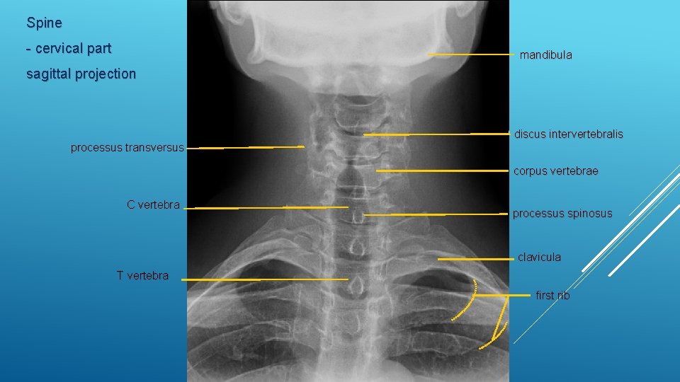 Spine - cervical part mandibula sagittal projection discus intervertebralis processus transversus corpus vertebrae C