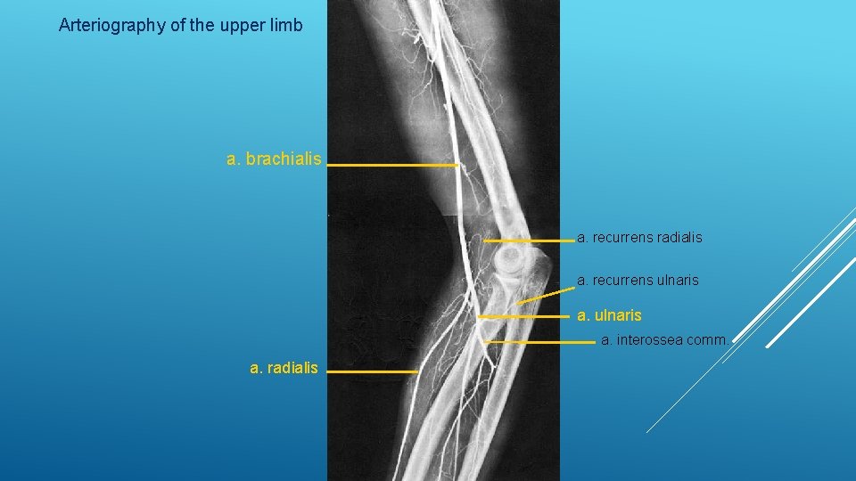 Arteriography of the upper limb a. brachialis a. recurrens radialis a. recurrens ulnaris a.