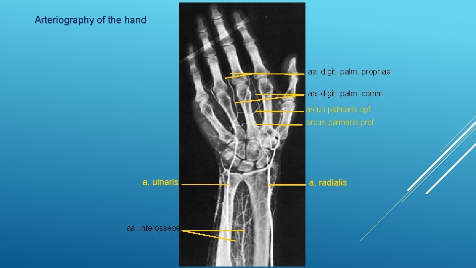Arteriography of the hand aa. digit. palm. propriae aa. digit. palm. comm. arcus palmaris