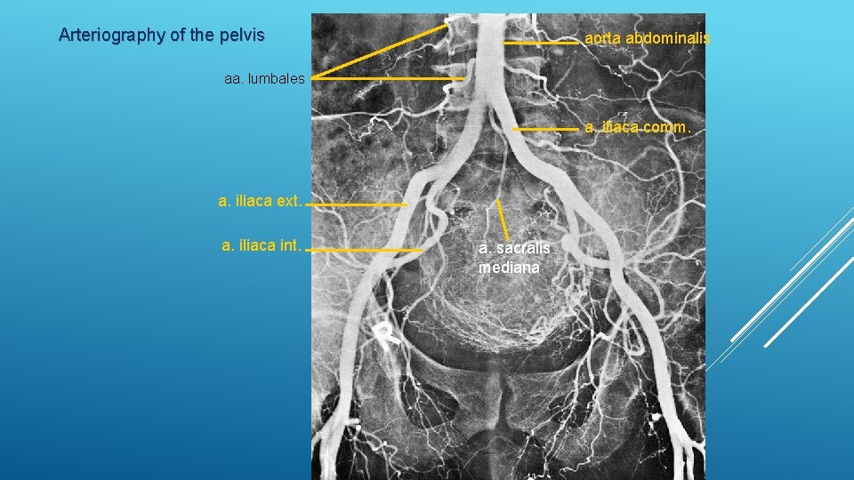 Arteriography of the pelvis aorta abdominalis aa. lumbales a. iliaca comm. a. iliaca ext.