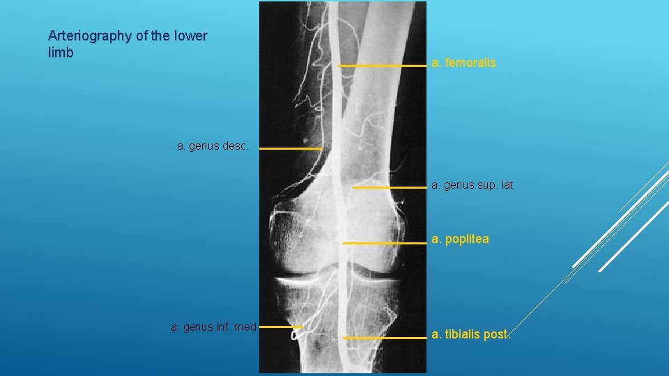 Arteriography of the lower limb a. femoralis a. genus desc. a. genus sup. lat