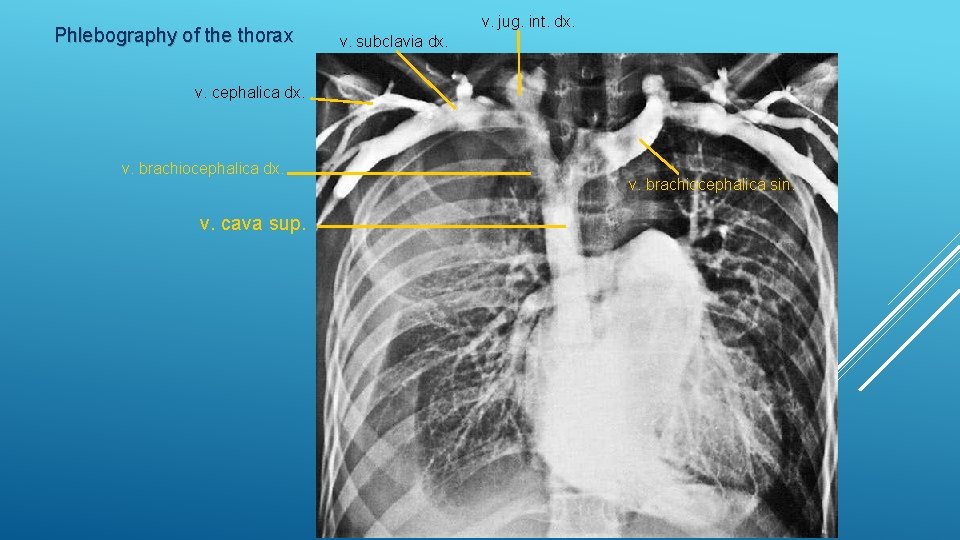 Phlebography of the thorax v. jug. int. dx. v. subclavia dx. v. cephalica dx.