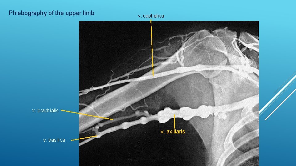 Phlebography of the upper limb v. cephalica v. brachialis v. axillaris v. basilica 