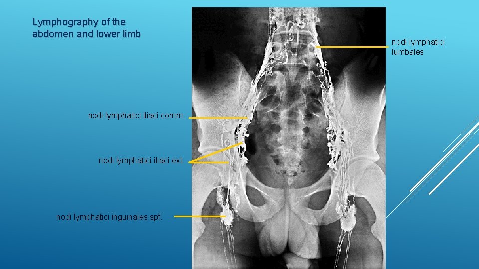 Lymphography of the abdomen and lower limb nodi lymphatici iliaci comm. nodi lymphatici iliaci
