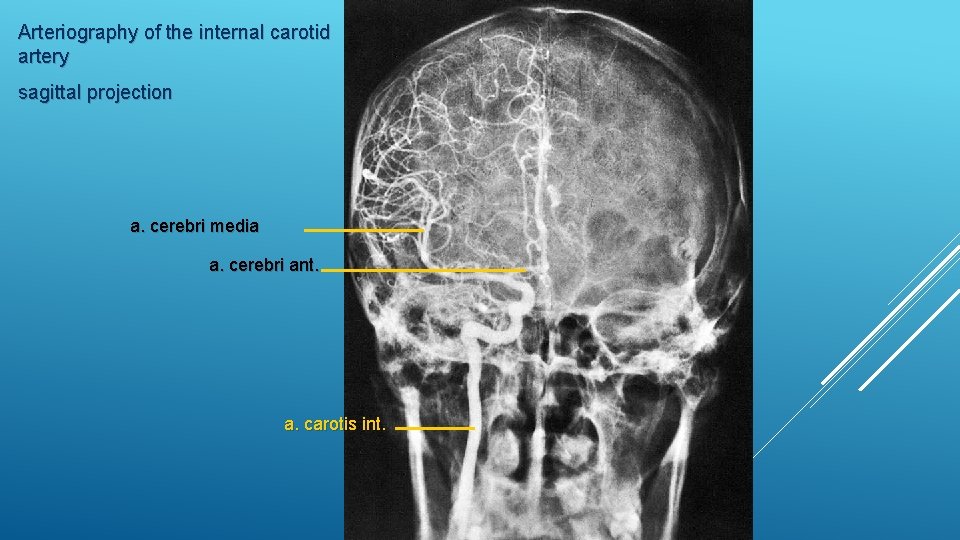 Arteriography of the internal carotid artery sagittal projection a. cerebri media a. cerebri ant.