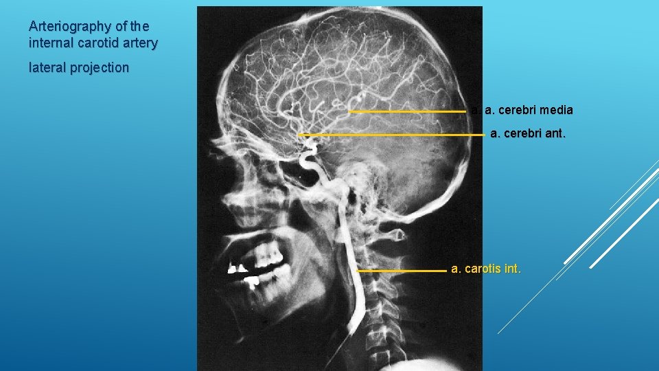 Arteriography of the internal carotid artery lateral projection a. a. cerebri media a. cerebri