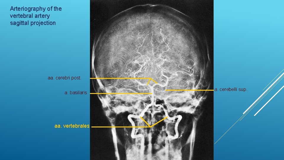 Arteriography of the vertebral artery sagittal projection aa. cerebri post. a. basilaris aa. vertebrales