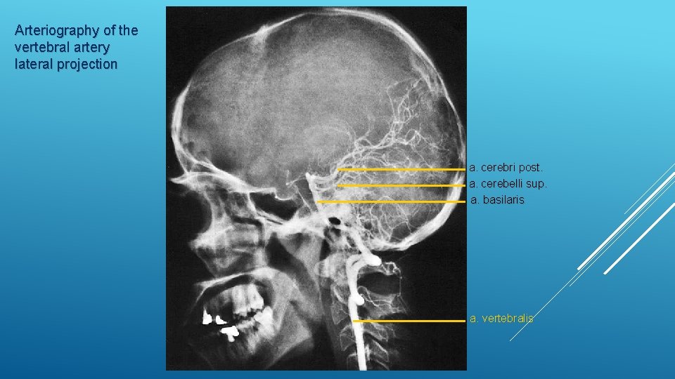 Arteriography of the vertebral artery lateral projection a. cerebri post. a. cerebelli sup. a.