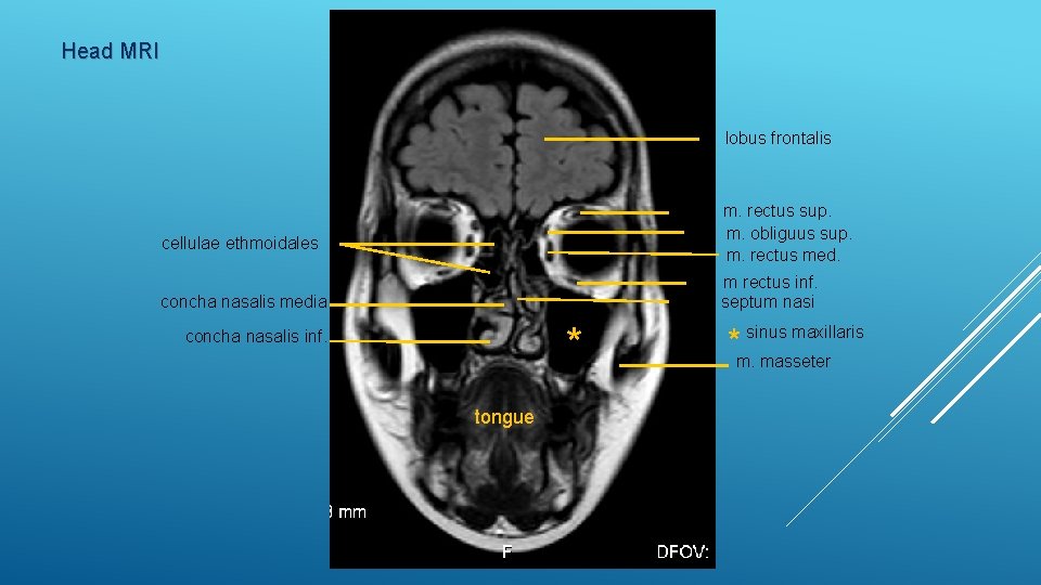 Head MRI lobus frontalis m. rectus sup. m. obliguus sup. m. rectus med. cellulae