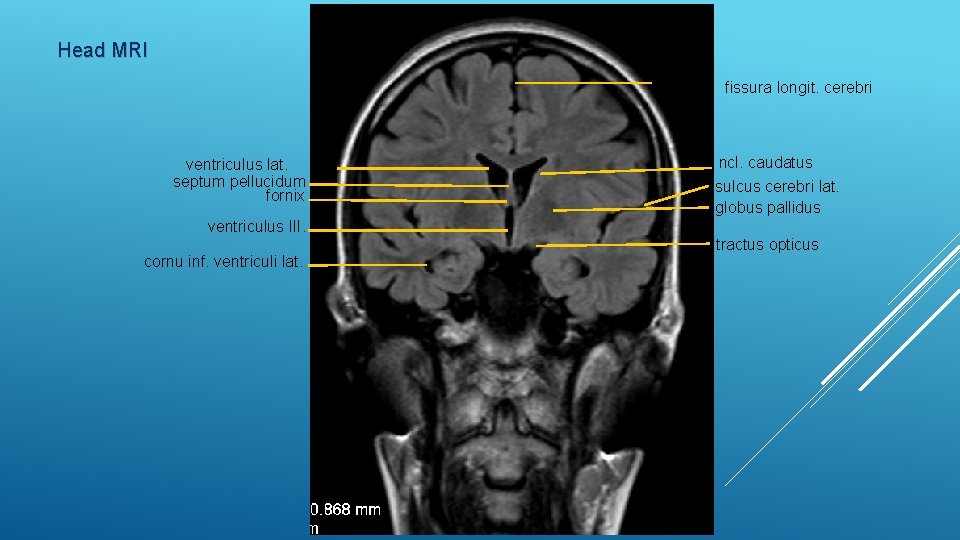 Head MRI fissura longit. cerebri ventriculus lat. septum pellucidum fornix ventriculus III. cornu inf.