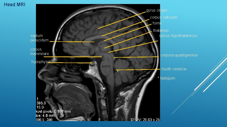 Head MRI gyrus cinguli corpus callosum fornix thalamus sulcus hypothalamicus septum pellucidum corpus mammilare