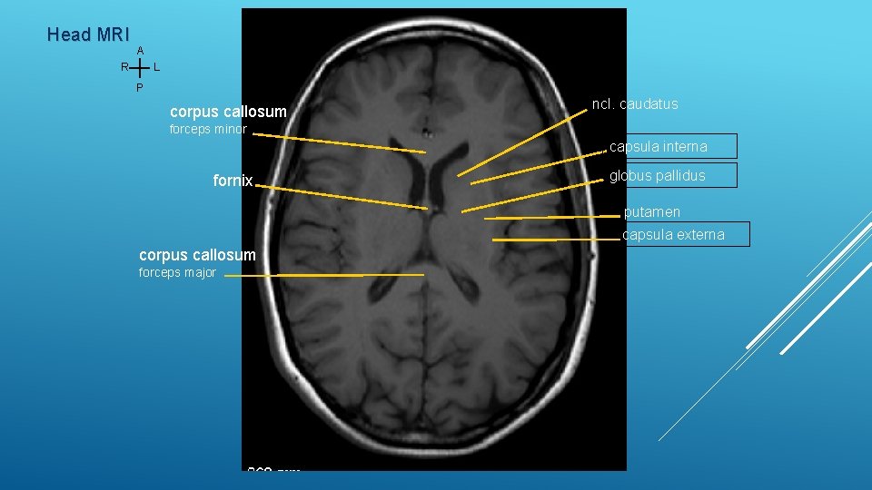 Head MRI A L R P corpus callosum ncl. caudatus forceps minor capsula interna