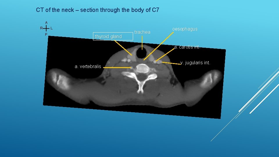 CT of the neck – section through the body of C 7 A L