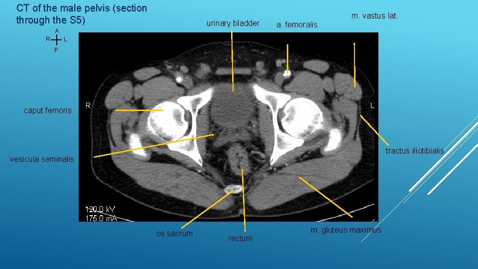 CT of the male pelvis (section through the S 5) urinary bladder A a.