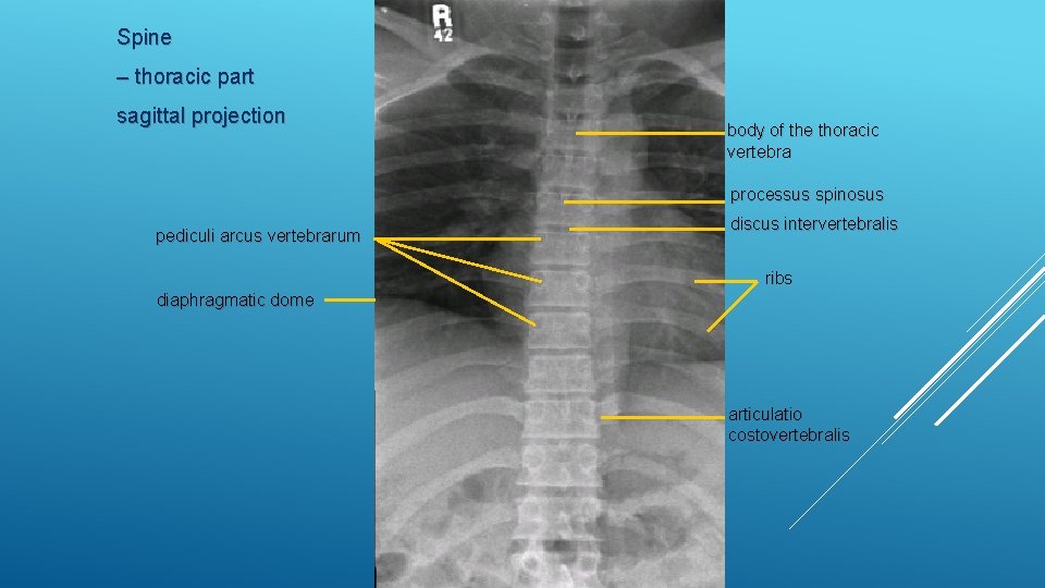 Spine – thoracic part sagittal projection body of the thoracic vertebra processus spinosus pediculi