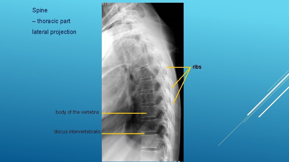 Spine – thoracic part lateral projection ribs body of the vertebra discus intervertebralis 