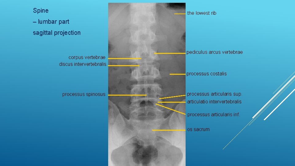 Spine the lowest rib – lumbar part sagittal projection corpus vertebrae discus intervertebralis pediculus