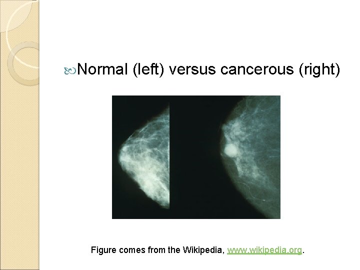  Normal (left) versus cancerous (right) Figure comes from the Wikipedia, www. wikipedia. org.