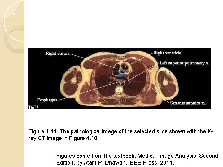 Figure 4. 11. The pathological image of the selected slice shown with the Xray