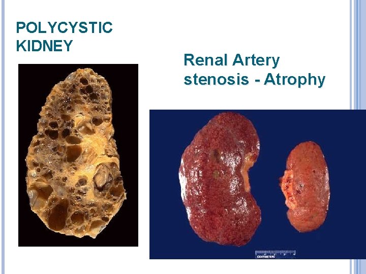POLYCYSTIC KIDNEY Renal Artery stenosis - Atrophy 
