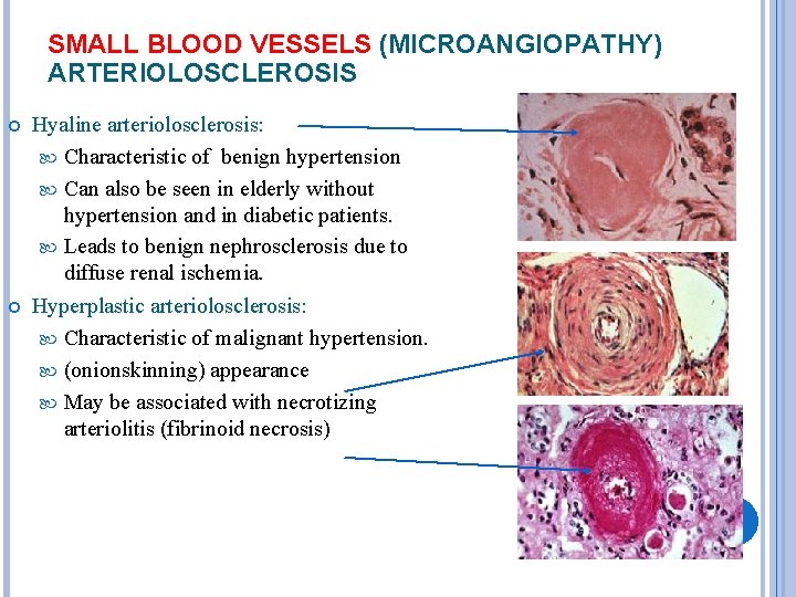 SMALL BLOOD VESSELS (MICROANGIOPATHY) ARTERIOLOSCLEROSIS Hyaline arteriolosclerosis: Characteristic of benign hypertension Can also be