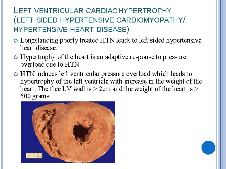 LEFT VENTRICULAR CARDIAC HYPERTROPHY (LEFT SIDED HYPERTENSIVE CARDIOMYOPATHY/ HYPERTENSIVE HEART DISEASE) Longstanding poorly treated