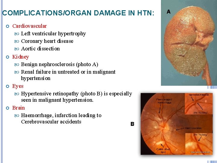 COMPLICATIONS/ORGAN DAMAGE IN HTN: Cardiovascular Left ventricular hypertrophy Coronary heart disease Aortic dissection Kidney