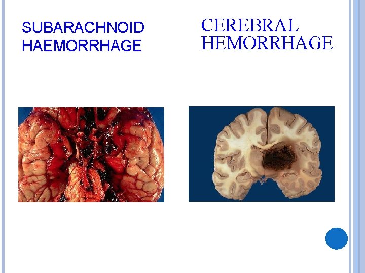 SUBARACHNOID HAEMORRHAGE CEREBRAL HEMORRHAGE 