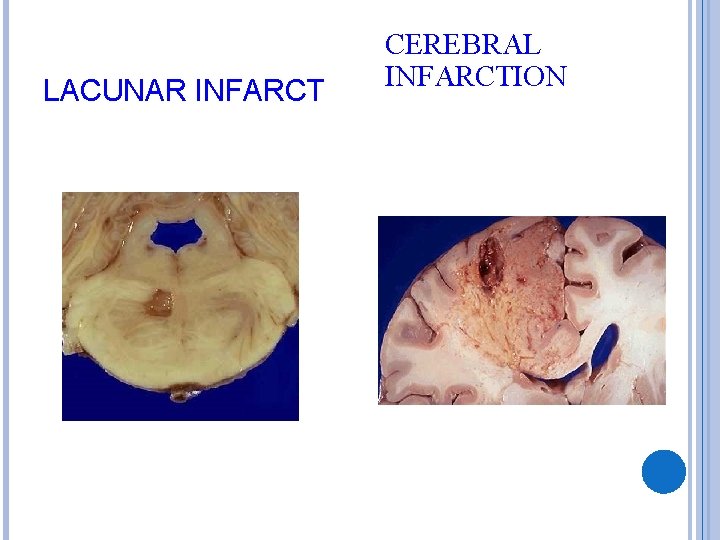 LACUNAR INFARCT CEREBRAL INFARCTION 