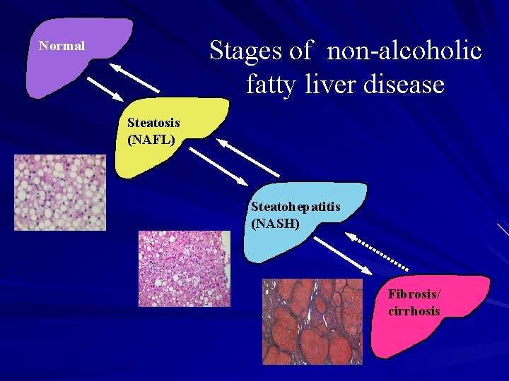 Stages of non-alcoholic fatty liver disease Normal Steatosis (NAFL) Steatohepatitis (NASH) Fibrosis/ cirrhosis 