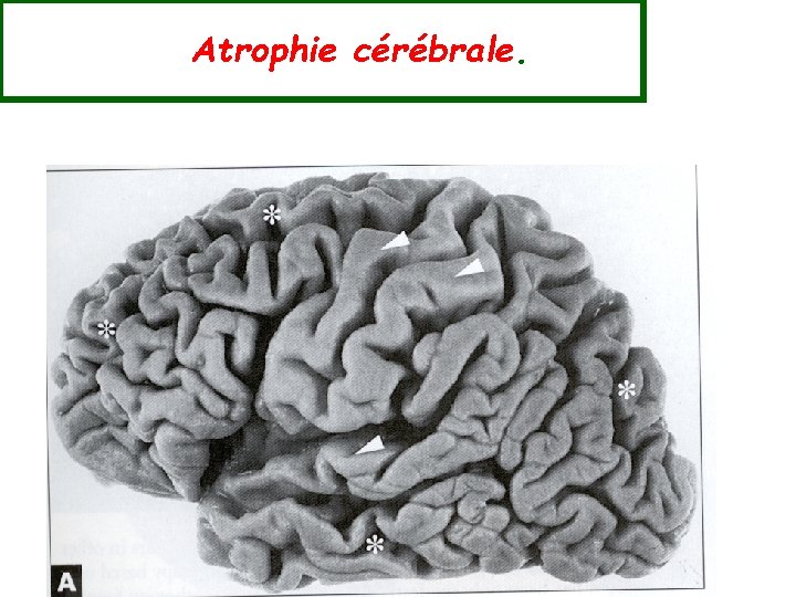 Atrophie cérébrale. 