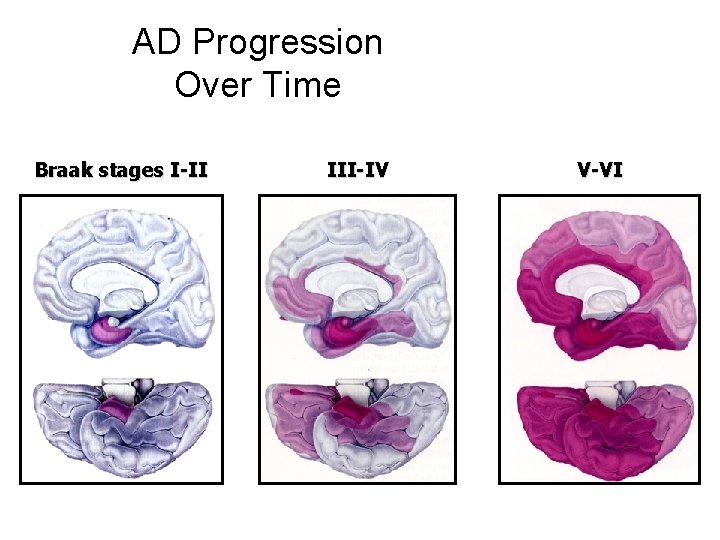 AD Progression Over Time Braak stages I-II III-IV V-VI 