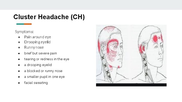 Cluster Headache (CH) Symptoms: ● Pain around eye ● Drooping eyelid ● Runny nose