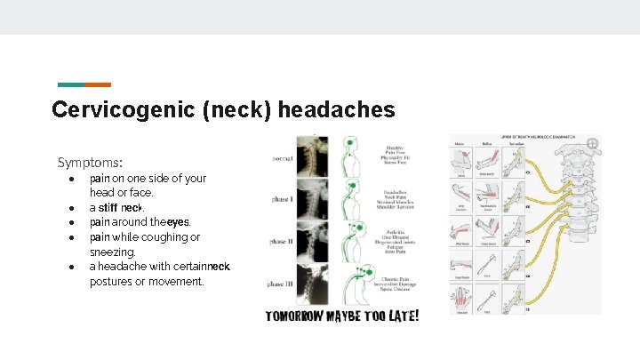 Cervicogenic (neck) headaches Symptoms: ● ● ● pain on one side of your head